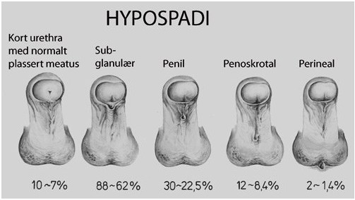 Hypospadias
