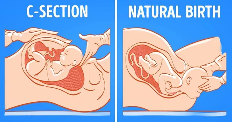 Normal Delivery vs C-Section