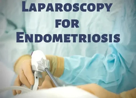 Laparoscopy For Endometriosis