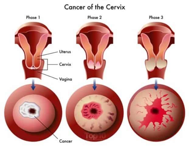 Hidden Signs of Cervical Cancer