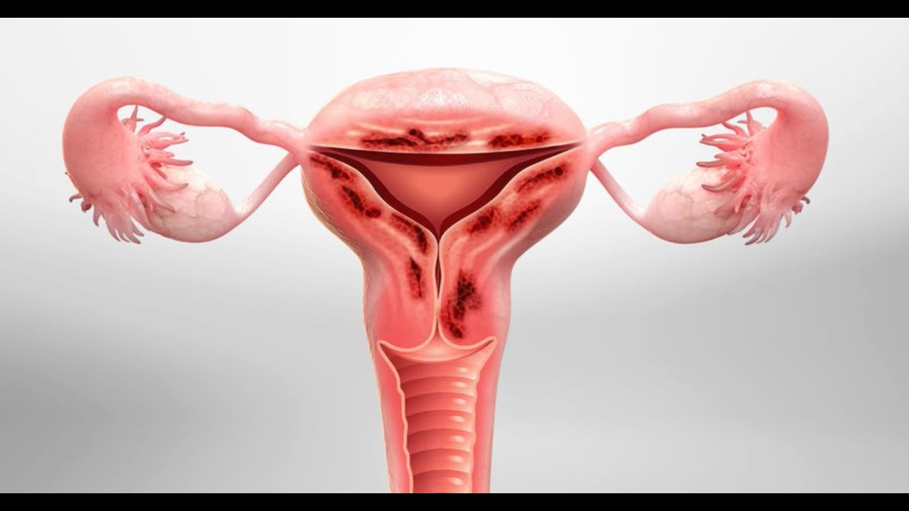 Understanding Adenomyosis