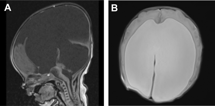 Hydrocephalus