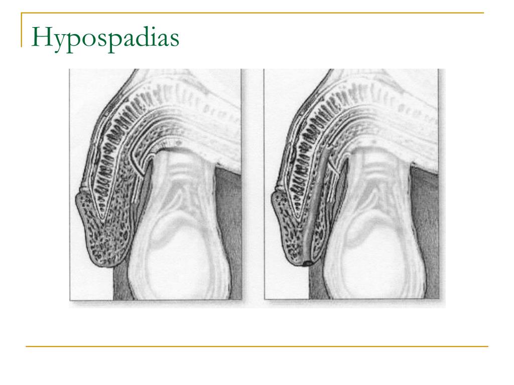 Hypospadias