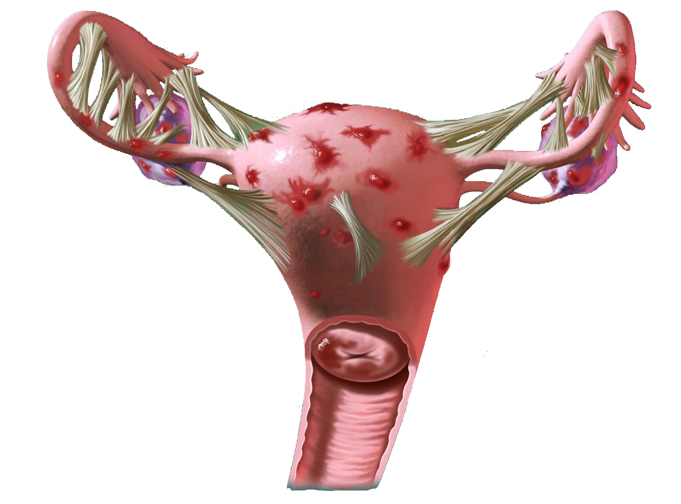 Endometriosis