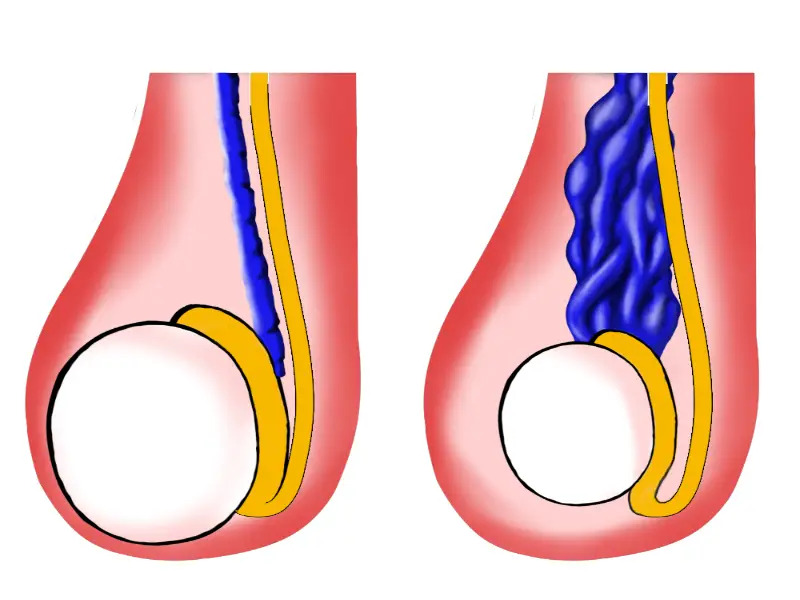 Undescended Testes