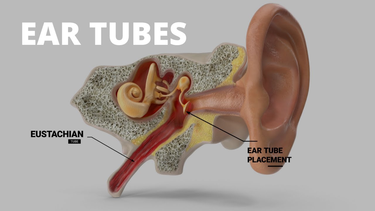 Ear Tubes