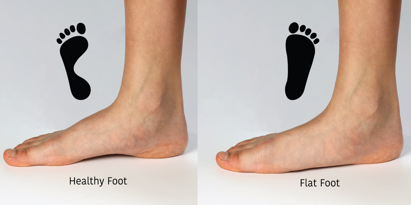 Flat Feet in Kids