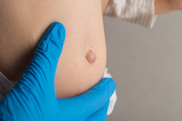 Hernia in Children