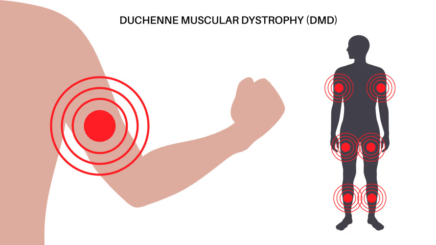 Duchenne Muscular Dystrophy